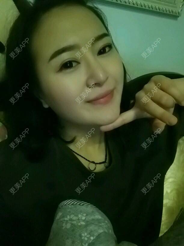 更美 - 종로페페 👧 👧的经验 | 自体脂肪垫下巴 | 全切双眼皮修复 | 衡阳