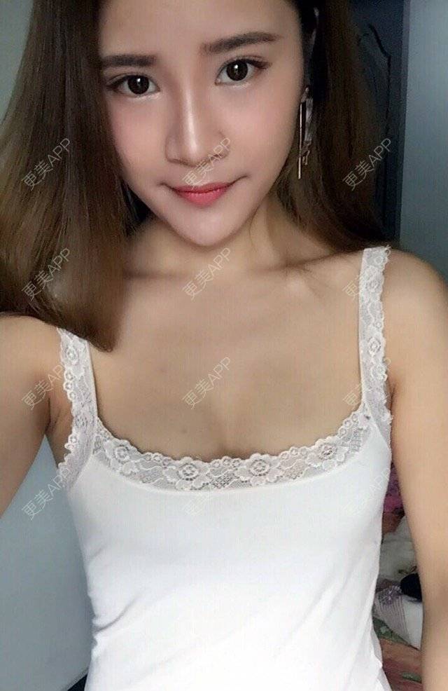 神经°的自体脂肪隆胸日记 | 美购日记 | 自体脂肪隆胸 | 丰胸(隆胸)