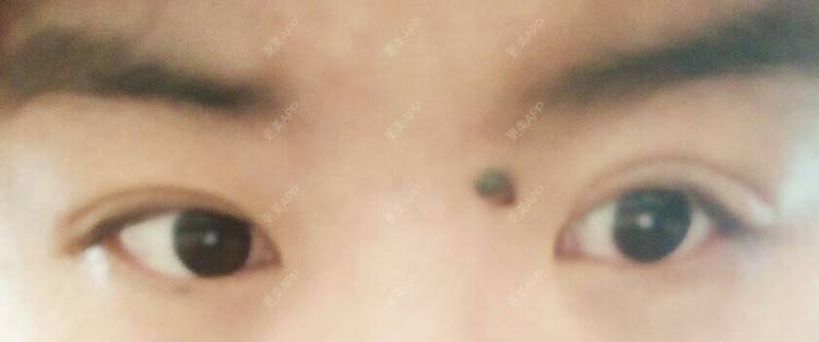 更美 - 林小喵^ω^的经验 | 眼睛整形 | 天津
