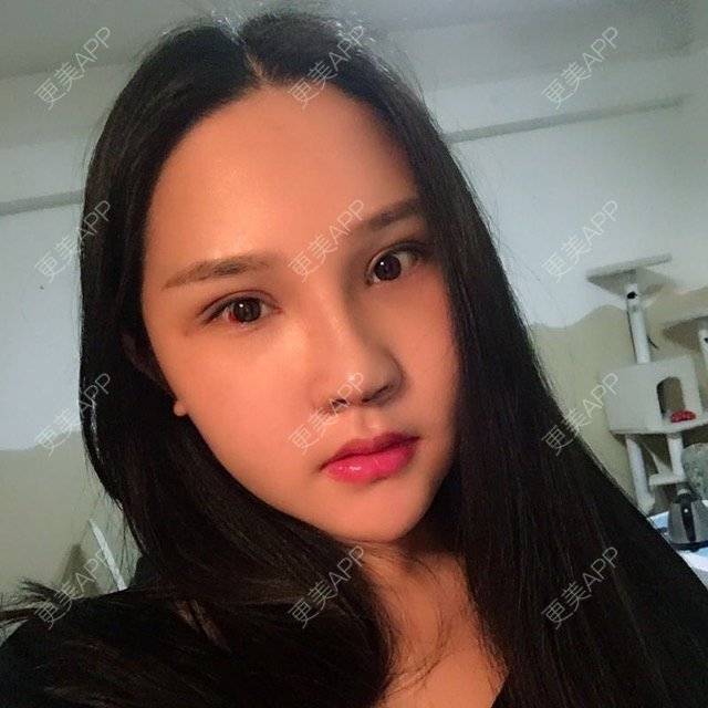 更美 - 欢___的肋软骨隆鼻经验 | 美购日记 | 打瘦脸针 | 肋软骨隆鼻 | 双眼皮 | 成都