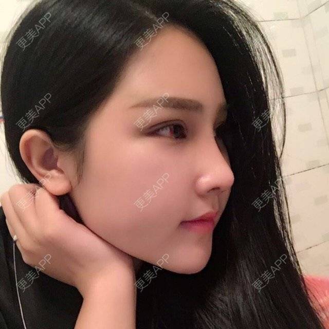 更美 - 欢___的肋软骨隆鼻经验 | 美购日记 | 打瘦脸针 | 肋软骨隆鼻 | 双眼皮 | 成都