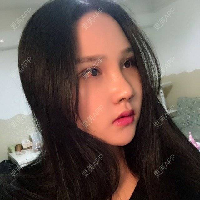 更美 - 欢___的肋软骨隆鼻经验 | 美购日记 | 打瘦脸针 | 肋软骨隆鼻 | 双眼皮 | 成都