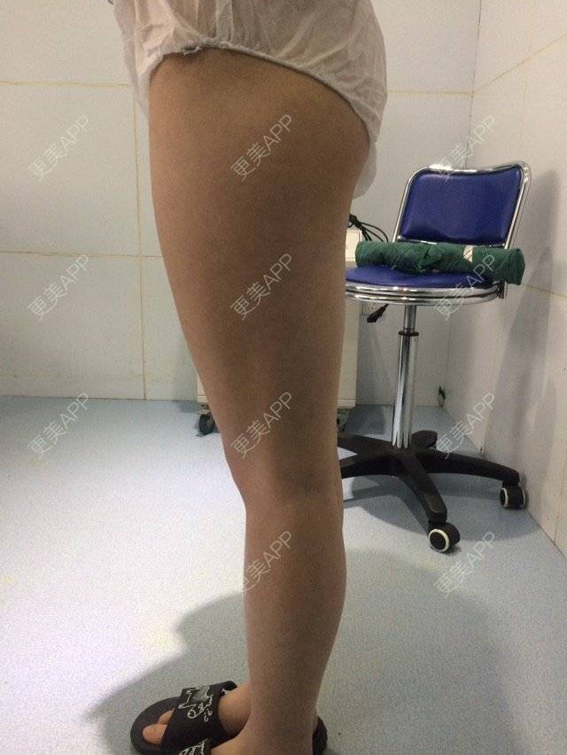 更美 - 筷子腿腿的经验 | 吸脂瘦腿 | 抽脂塑形 | 抽脂瘦大腿 | 郑州