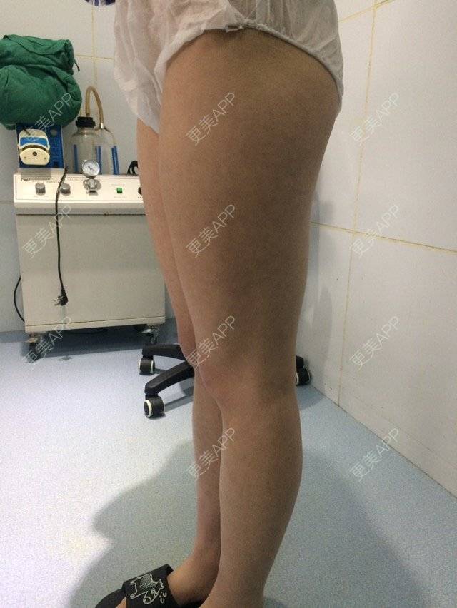 更美 - 筷子腿腿的经验 | 吸脂瘦腿 | 抽脂塑形 | 抽脂瘦大腿 | 郑州