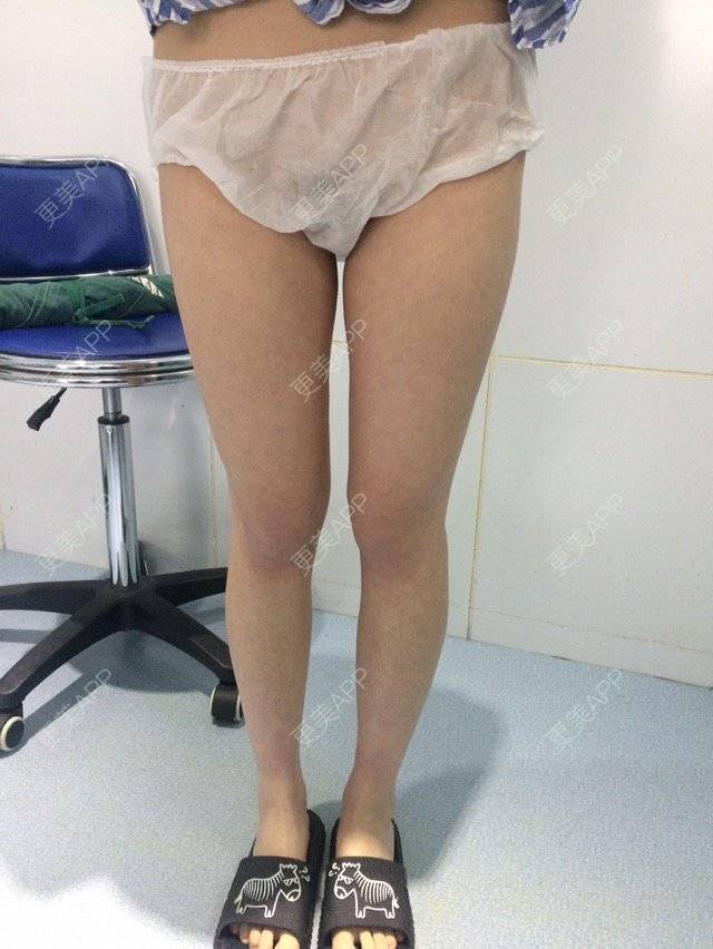 更美 - 筷子腿腿的经验 | 吸脂瘦腿 | 抽脂塑形 | 抽脂瘦大腿 | 郑州