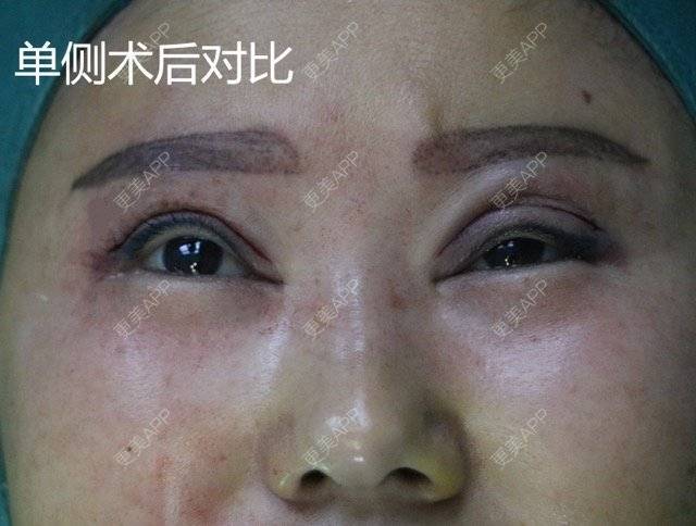 更美 - 魏志香 医生的经验 | 眼部整形 | 眼部整形1 | 北京