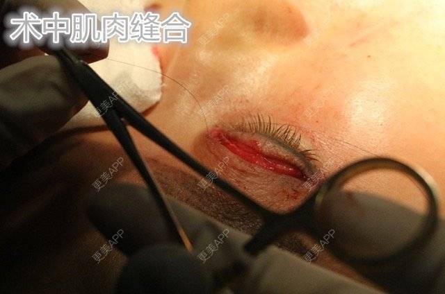 更美 - 魏志香 医生的经验 | 眼部整形 | 眼部整形1 | 北京
