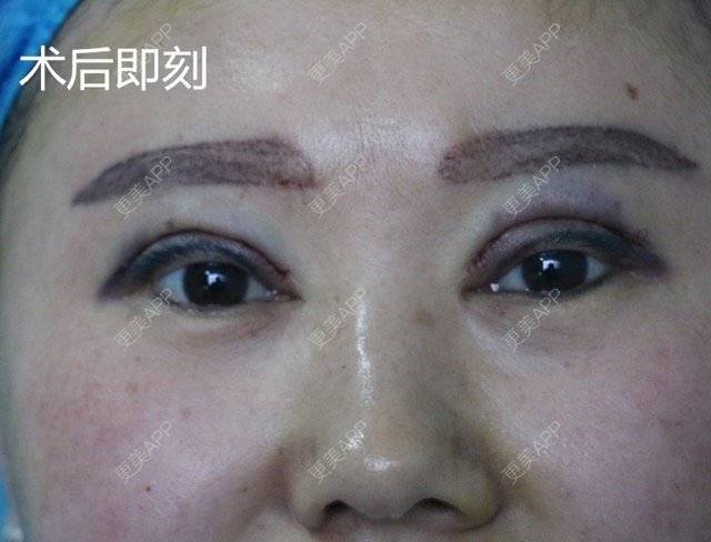 更美 - 魏志香 医生的经验 | 眼部整形 | 眼部整形1 | 北京