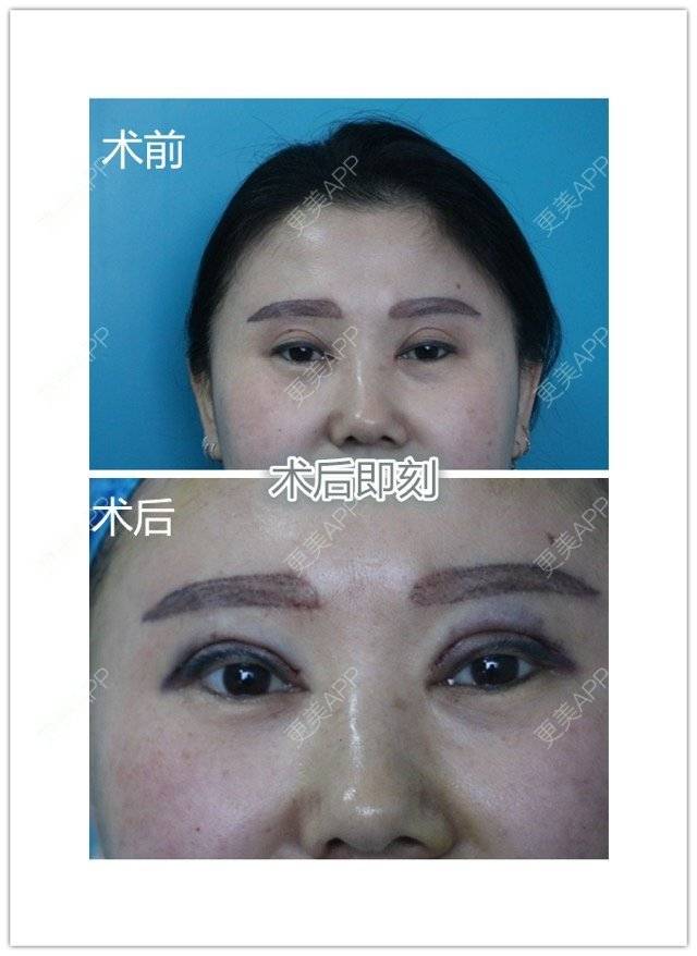 更美 - 魏志香 医生的经验 | 眼部整形 | 眼部整形1 | 北京