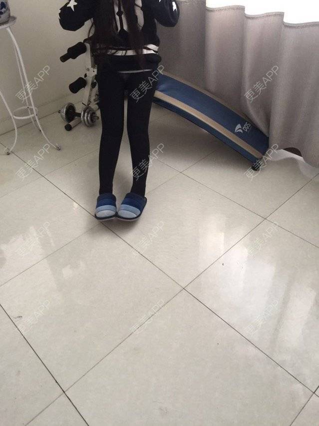 更美 - 慢漫曼小姐的吸脂瘦大腿经验 | 宁波 | 吸脂瘦大腿