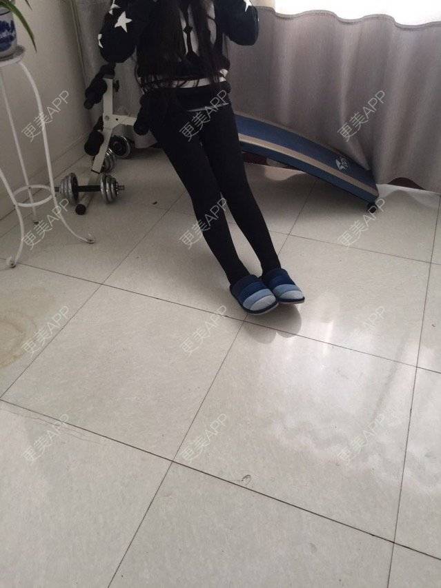 更美 - 慢漫曼小姐的吸脂瘦大腿经验 | 宁波 | 吸脂瘦大腿