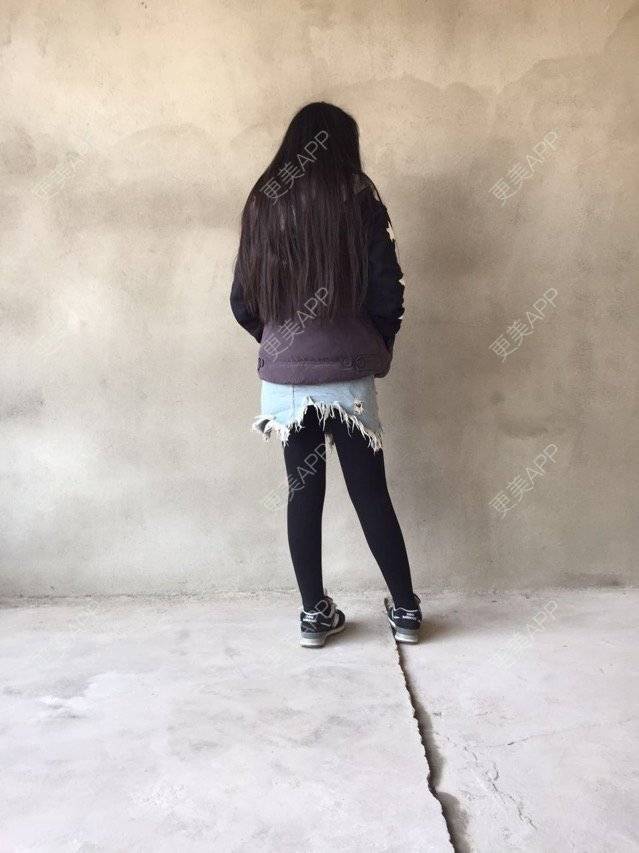 更美 - 慢漫曼小姐的吸脂瘦大腿经验 | 宁波 | 吸脂瘦大腿