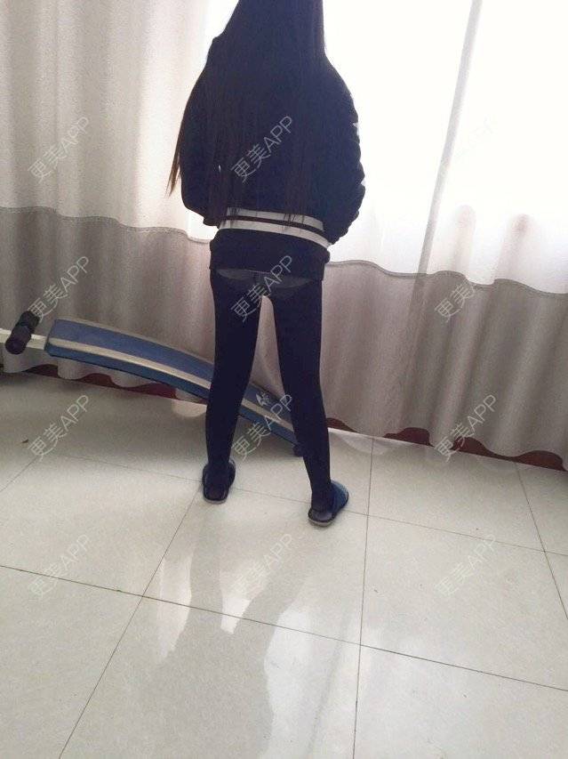 更美 - 慢漫曼小姐的吸脂瘦大腿经验 | 宁波 | 吸脂瘦大腿