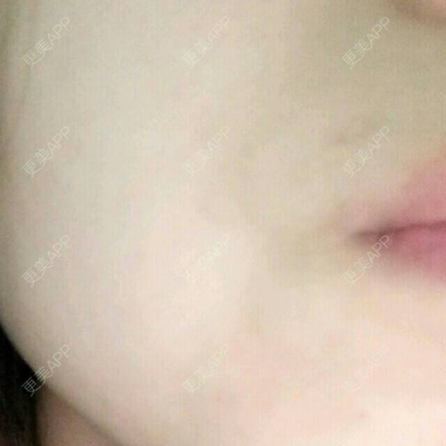 更美 - ejeidjbf的经验 | 去除疤痕 | 辽阳