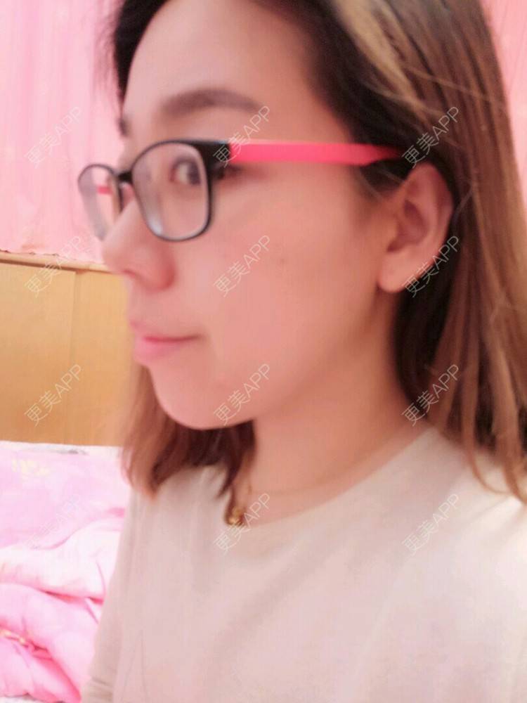 更美 - 糖葫芦滚雪球儿的经验 | 瘦脸针下巴 | 北京
