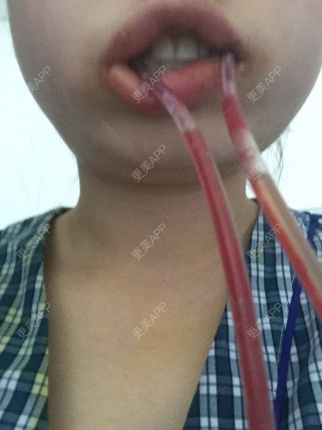 更美 - 骄傲1024的颧骨颧弓经验 | 下颌角. | 咬肌 | 颧骨颧弓 | 西安