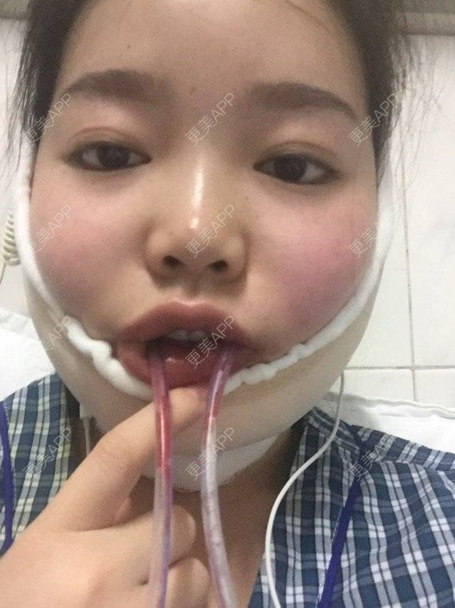 更美 - 骄傲1024的颧骨颧弓经验 | 下颌角. | 咬肌 | 颧骨颧弓 | 西安