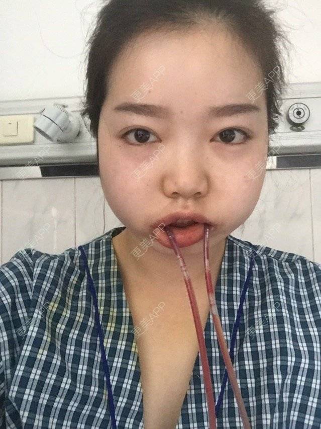 更美 - 骄傲1024的颧骨颧弓经验 | 下颌角. | 咬肌 | 颧骨颧弓 | 西安