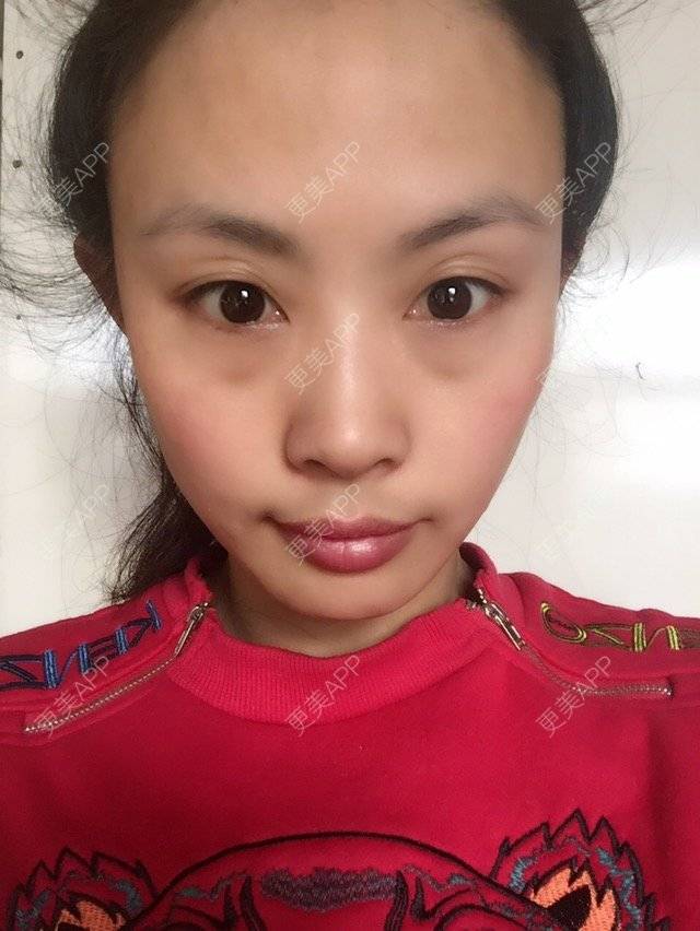 更美 - 更美用户5sTiaw2GDc的经验 | 双眼皮眼袋