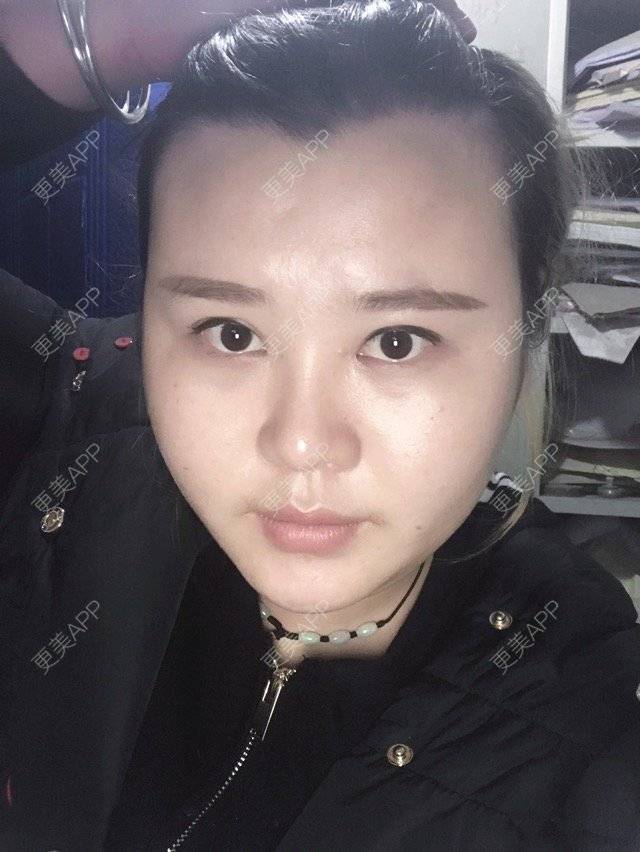 更美 - 👿没有蜡笔的小新的经验 | 植发际线 | 昆明