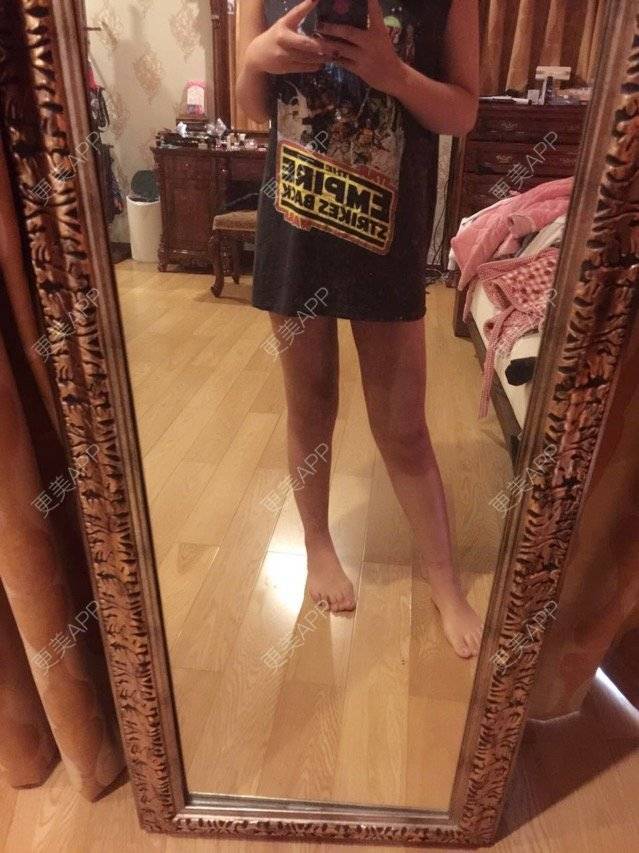 更美 - 慢漫曼小姐的吸脂瘦大腿经验 | 宁波 | 吸脂瘦大腿