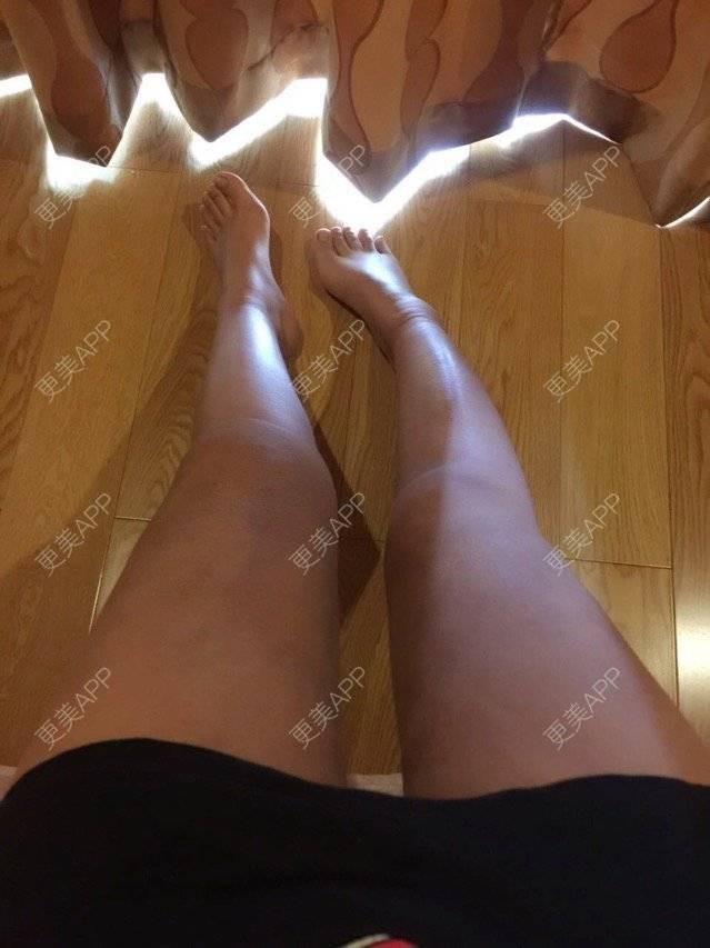 更美 - 慢漫曼小姐的吸脂瘦大腿经验 | 宁波 | 吸脂瘦大腿
