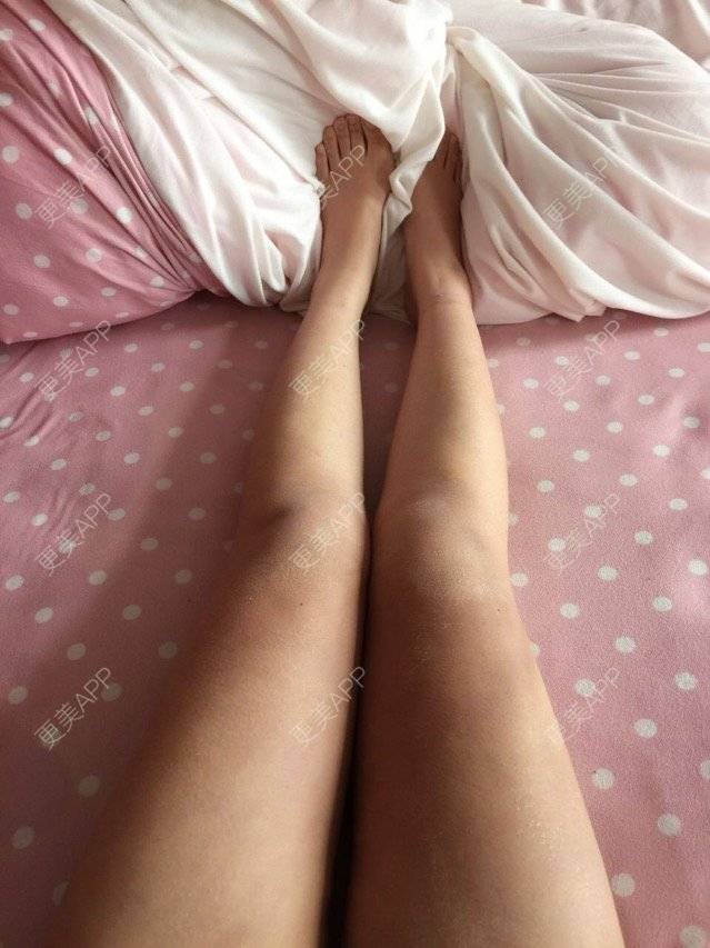 更美 - 慢漫曼小姐的吸脂瘦大腿经验 | 宁波 | 吸脂瘦大腿