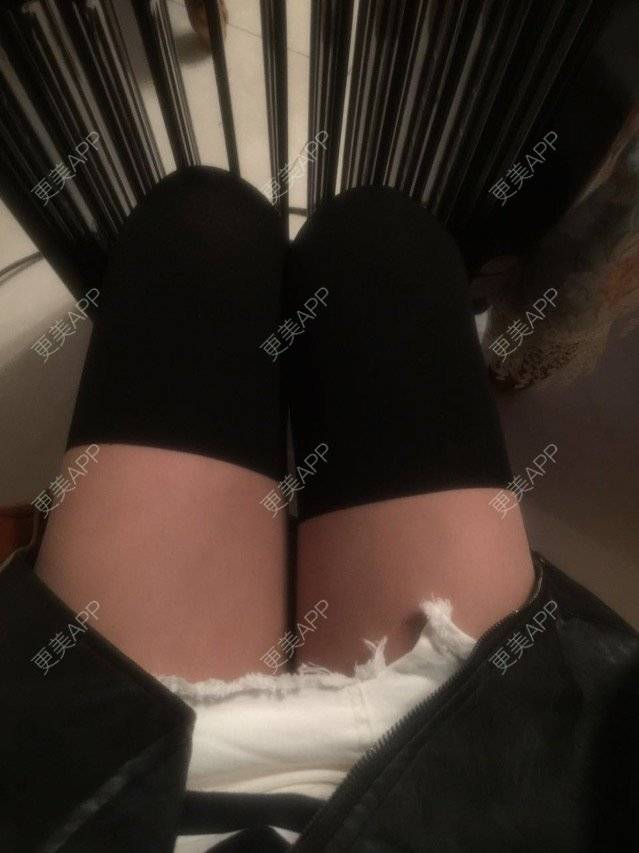 更美 - 慢漫曼小姐的吸脂瘦大腿经验 | 宁波 | 吸脂瘦大腿