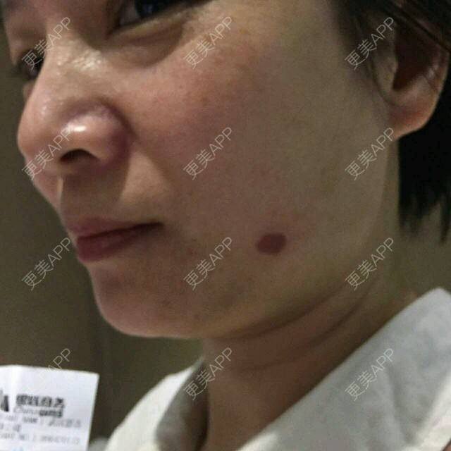 更美 - 玉兰花。的激光淡斑经验 | 老年斑 | 激光淡斑 | 武汉同城 | 武汉