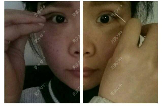 更美 - 小诚子Y的经验 | 割双眼皮 | 南昌
