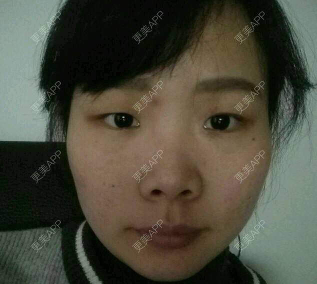 更美 - 小诚子Y的经验 | 割双眼皮 | 南昌