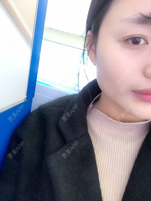 更美 - 咧哥的经验 | 进口瘦脸针 | 蚌埠