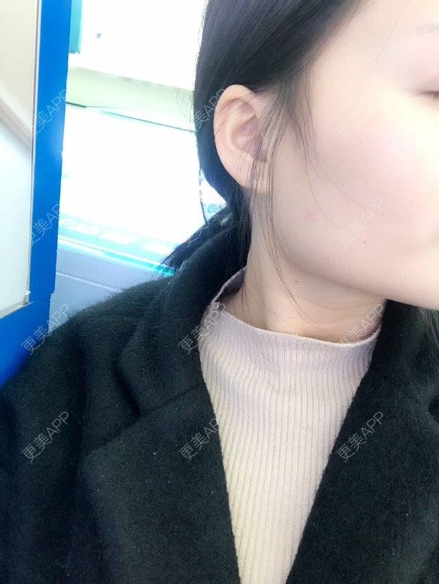 更美 - 咧哥的经验 | 进口瘦脸针 | 蚌埠