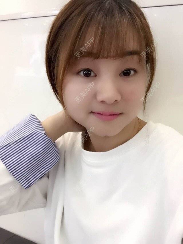 更美 - Mimo 兰的眼皮下垂矫正经验 | 上海 | 眼皮下垂矫正