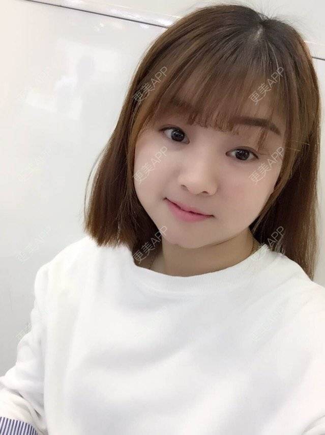 更美 - Mimo 兰的眼皮下垂矫正经验 | 上海 | 眼皮下垂矫正