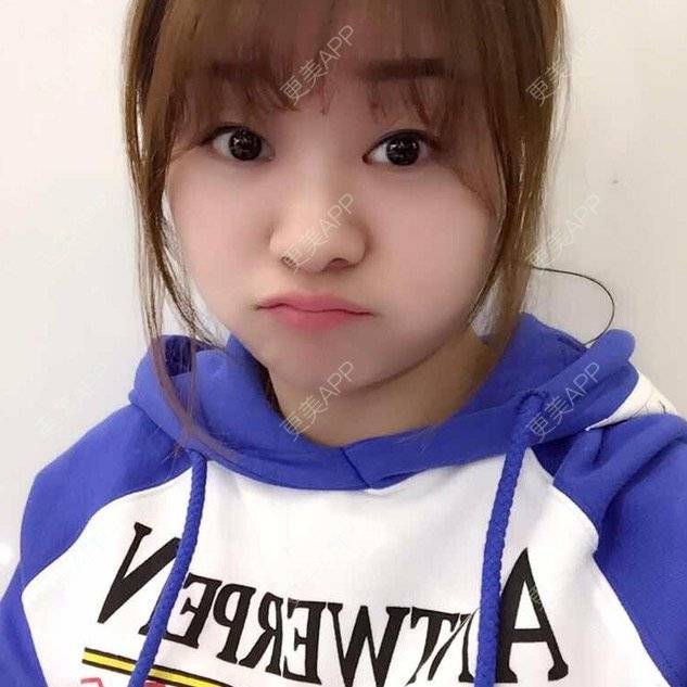 更美 - Mimo 兰的眼皮下垂矫正经验 | 上海 | 眼皮下垂矫正