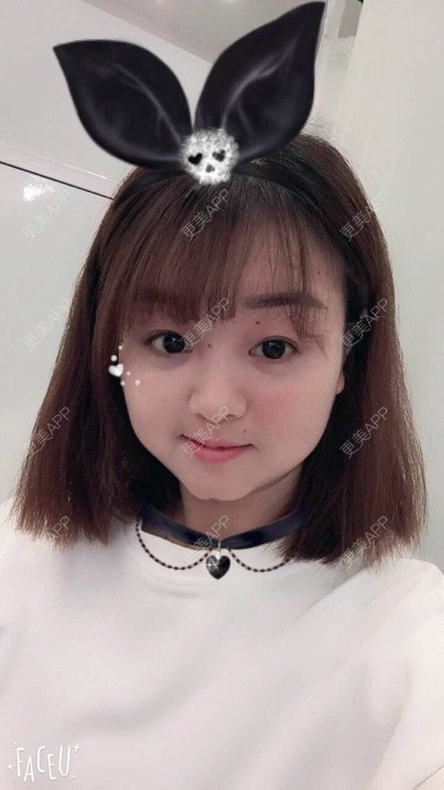 更美 - Mimo 兰的眼皮下垂矫正经验 | 上海 | 眼皮下垂矫正