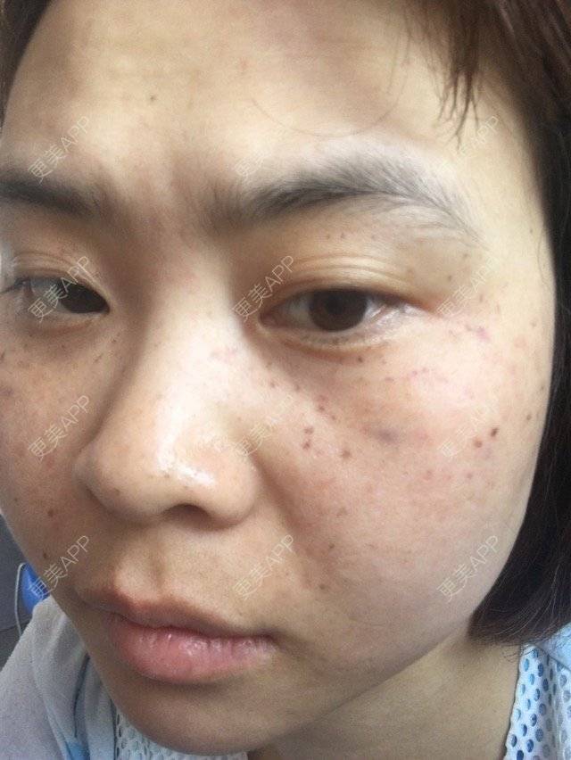 更美 - 圆婷的经验 | 激光淡斑 | 长沙