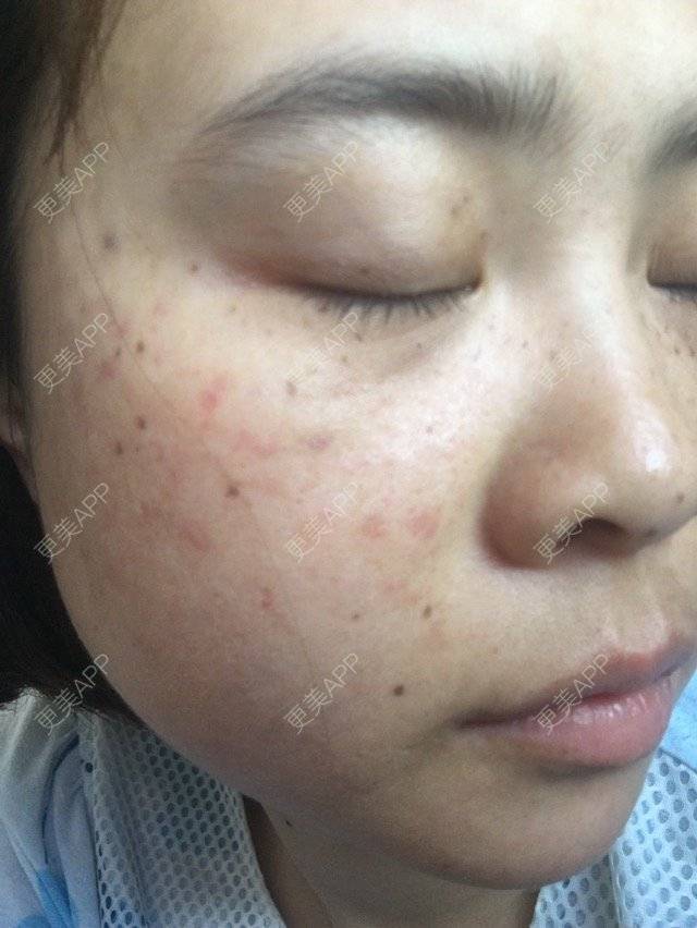 更美 - 圆婷的经验 | 激光淡斑 | 长沙