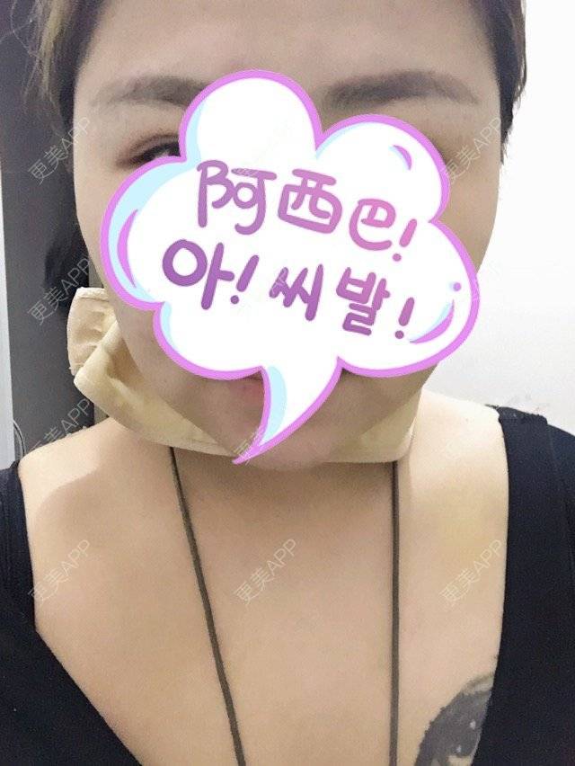 更美 - 大袁袁袁袁的经验 | 注射塑形肩部