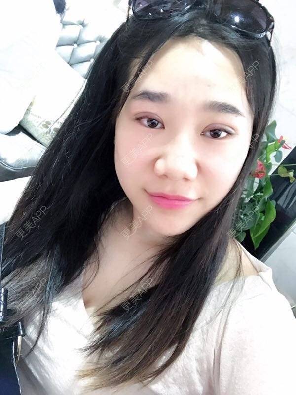 更美 - 更美用户fVk573DzdJ的定点双眼皮经验 | DD数码双眼皮 | 术后求抱抱 | 定点双眼皮 | 深圳