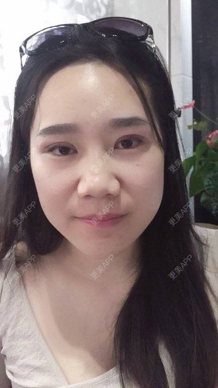 更美 - 更美用户fVk573DzdJ的定点双眼皮经验 | DD数码双眼皮 | 术后求抱抱 | 定点双眼皮 | 深圳