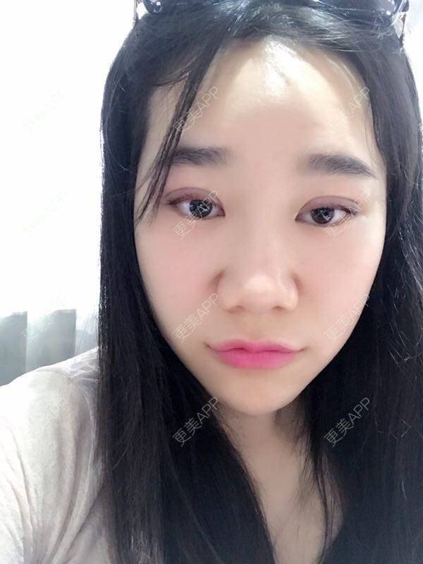更美 - 更美用户fVk573DzdJ的定点双眼皮经验 | DD数码双眼皮 | 术后求抱抱 | 定点双眼皮 | 深圳