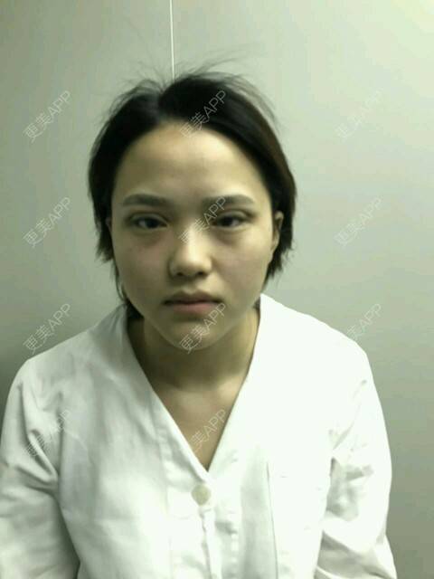 更美 - 更美用户J8yCXXJxvT的定点双眼皮经验 | 定点双眼皮 | 深圳 | DD数码双眼皮