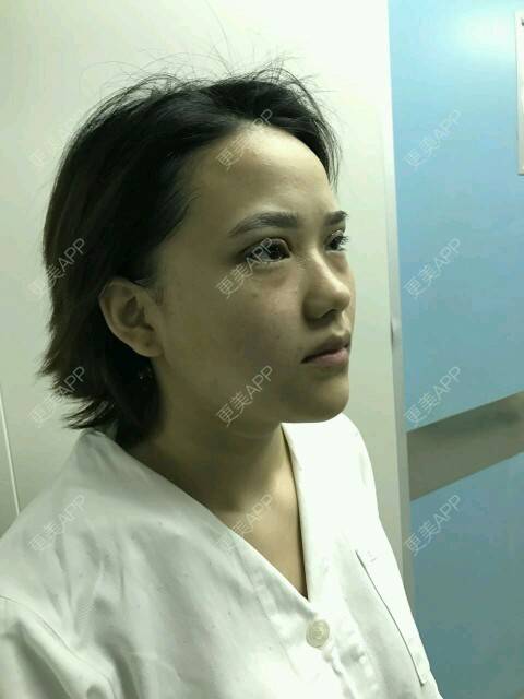 更美 - 更美用户J8yCXXJxvT的定点双眼皮经验 | 定点双眼皮 | 深圳 | DD数码双眼皮