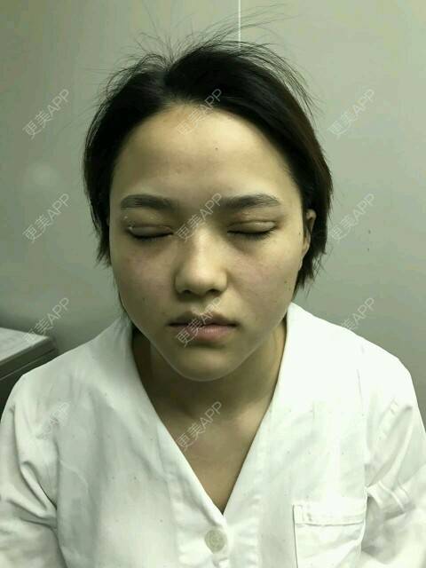 更美 - 更美用户J8yCXXJxvT的定点双眼皮经验 | 定点双眼皮 | 深圳 | DD数码双眼皮