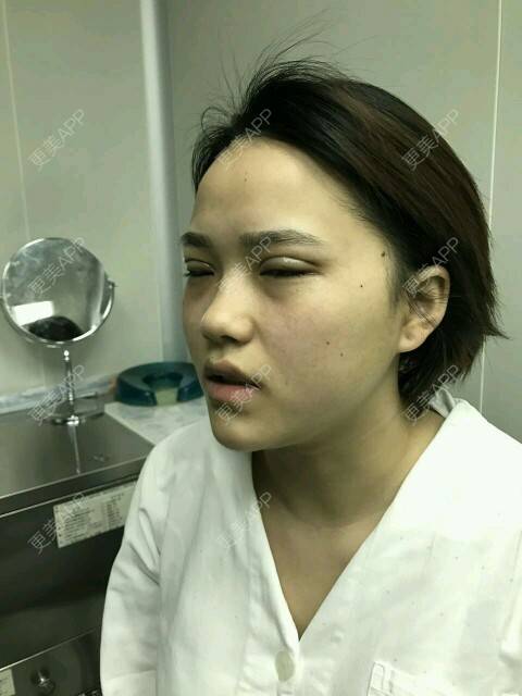 更美 - 更美用户J8yCXXJxvT的定点双眼皮经验 | 定点双眼皮 | 深圳 | DD数码双眼皮