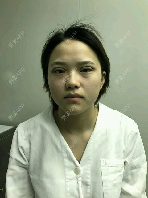 更美 - 更美用户J8yCXXJxvT的定点双眼皮经验 | 定点双眼皮 | 深圳 | DD数码双眼皮