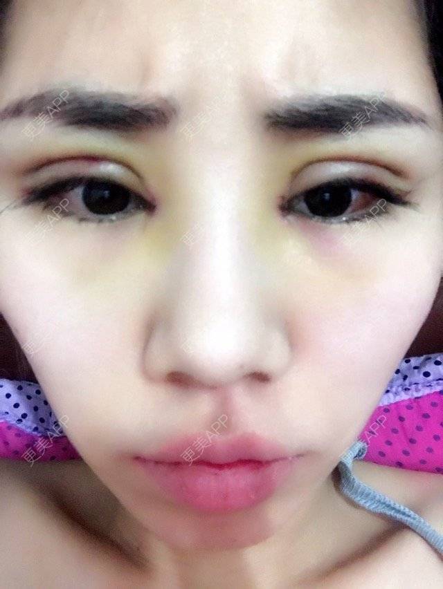 更美 - AA 💋瑶瑶。万达日租的双眼皮经验 | 外开眼角 | 开眼角 | 双眼皮 | 长春