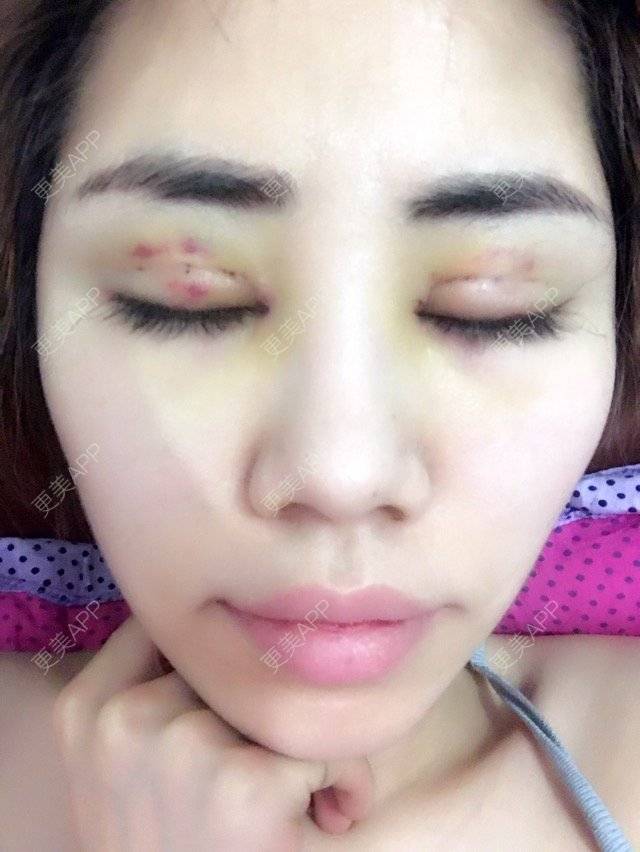 更美 - AA 💋瑶瑶。万达日租的双眼皮经验 | 外开眼角 | 开眼角 | 双眼皮 | 长春
